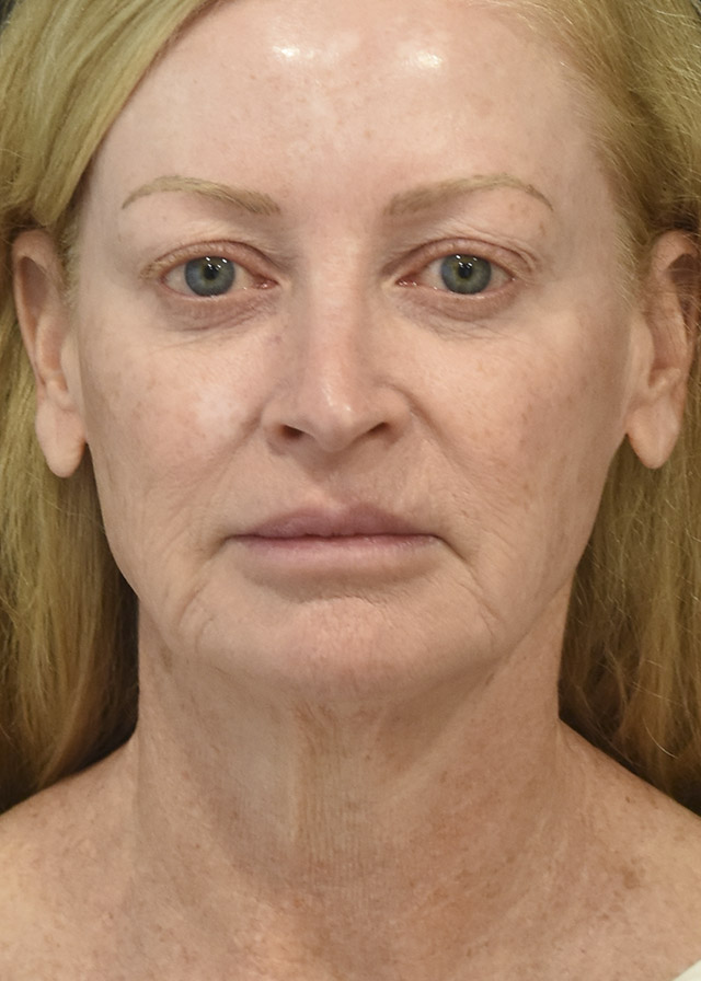 Neck Lift Patient 45 Set 1 Before